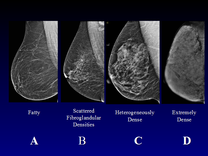 What's Dense Breast Tissue and What Can You Do About It?