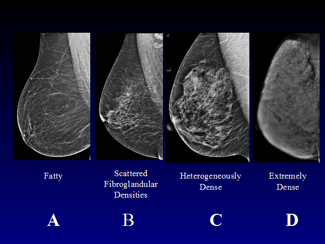 What Should You Know About Breast Density Breast Cancer Awareness Month Women S Health Research Institute